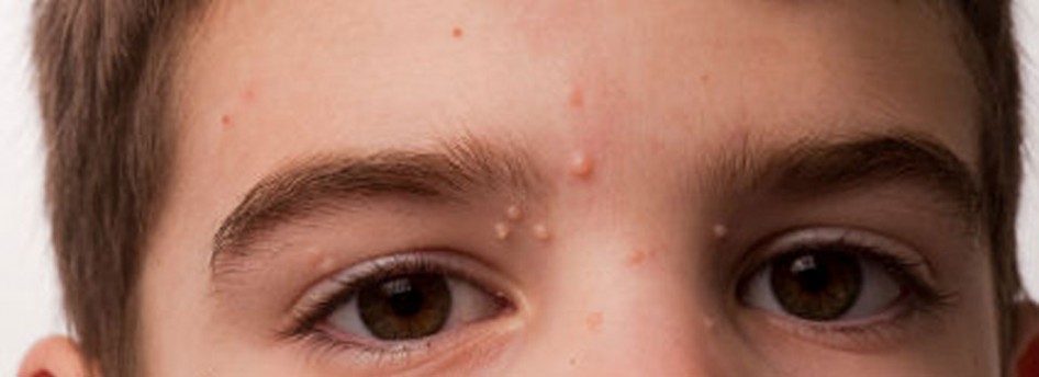 about_mollluscum_chld
