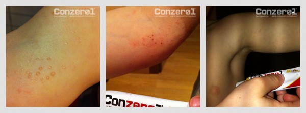 before-after-molluscum-contagiousm-1