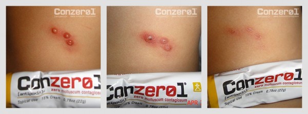 before-after-molluscum-contagiousm-2