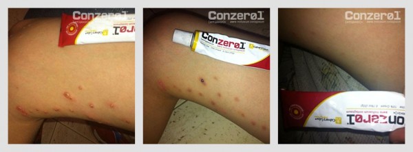 before-after-molluscum-contagiousm-3