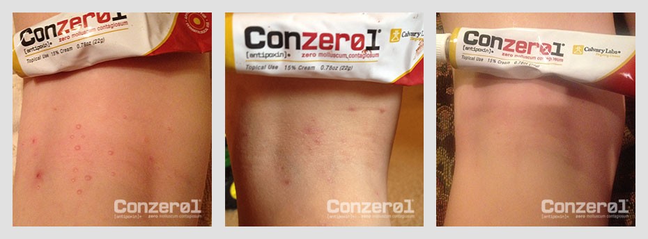 before-after-molluscum-contagiousm-4