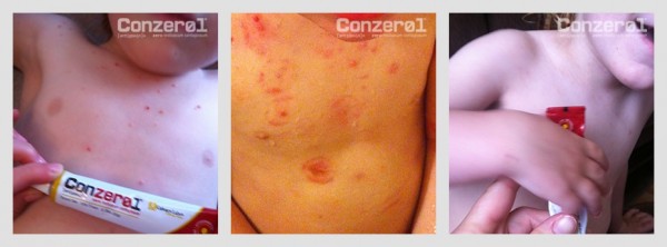 before-after-molluscum-contagiousm-5