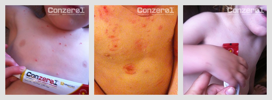 before-after-molluscum-contagiousm-5