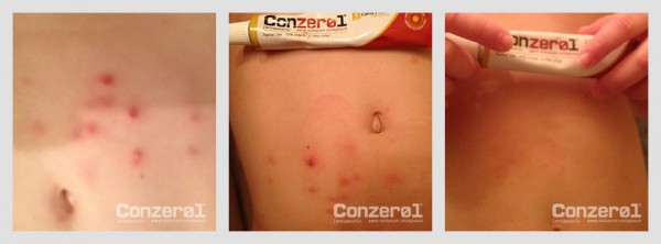 before-after-molluscum-contagiousm-6