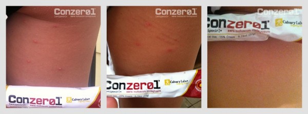 before-after-molluscum-contagiousm-8