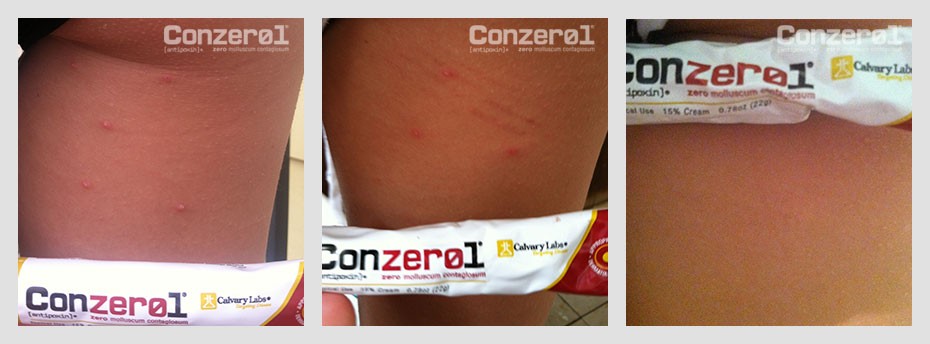 before-after-molluscum-contagiousm-8