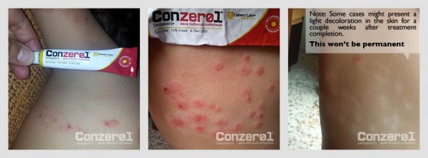 before-after-molluscum-contagiousm-9