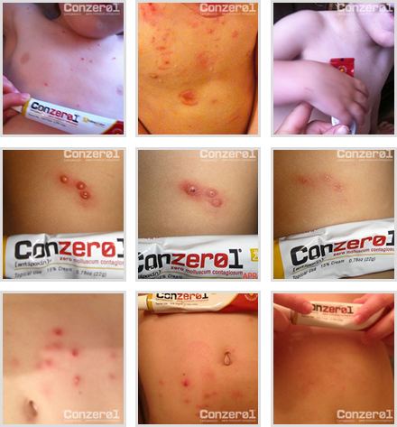 Pictures of Molluscum Contagiosum