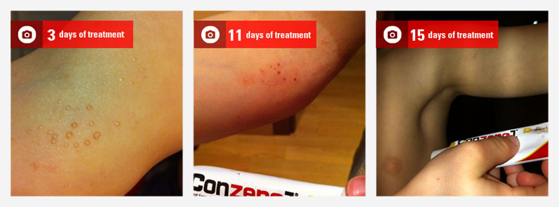 molluscum-picture-01