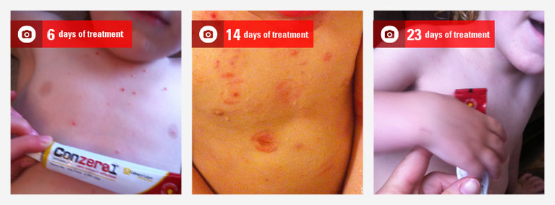 molluscum-picture-02