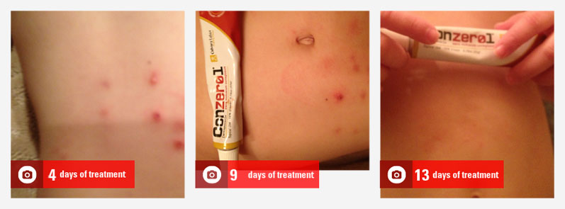 molluscum-picture-03