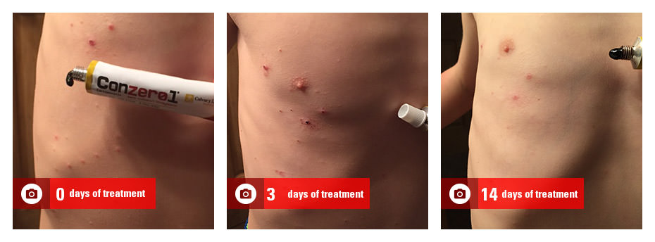 before-after-molluscum-contagiousm-treatment_lori