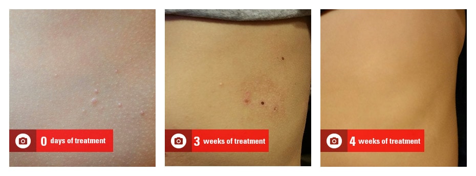 molluscum-treatment-nov-15-jaime